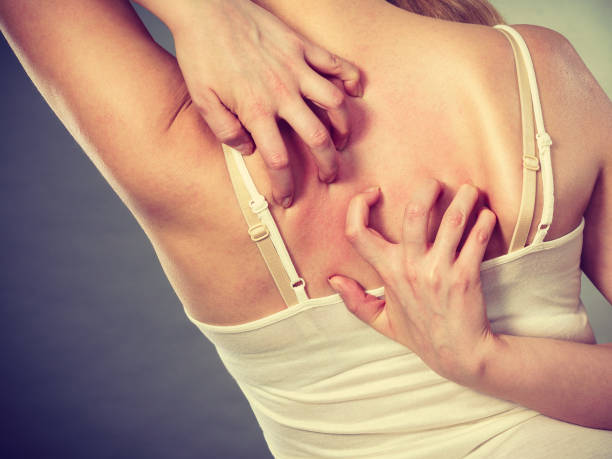 istock woman scratching her itchy back with allergy rash 1175927410