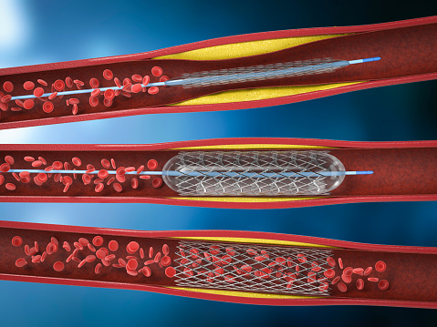3d rendering balloon angioplasty procedure with stent in vein