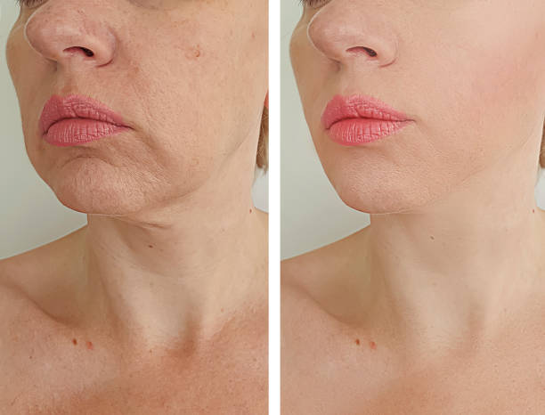 wrinkles woman face before and after treatment wrinkles woman face before and after treatment botox before and after stock pictures, royalty-free photos & images