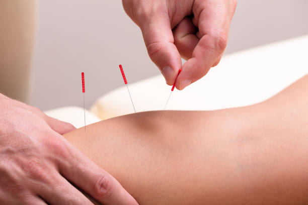 istock Therapist Giving Acupuncture Treatment On Woman's Knee 1176206229