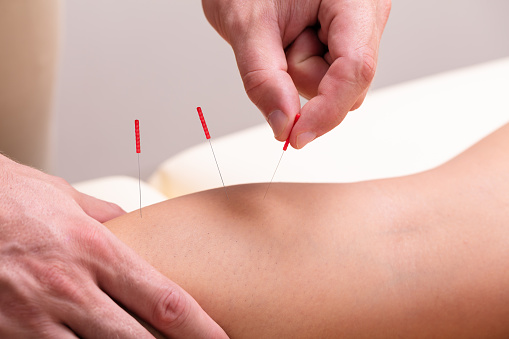 Close-up Of A Therapist Giving Acupuncture Treatment By Inserting Needles On Woman's Knee
