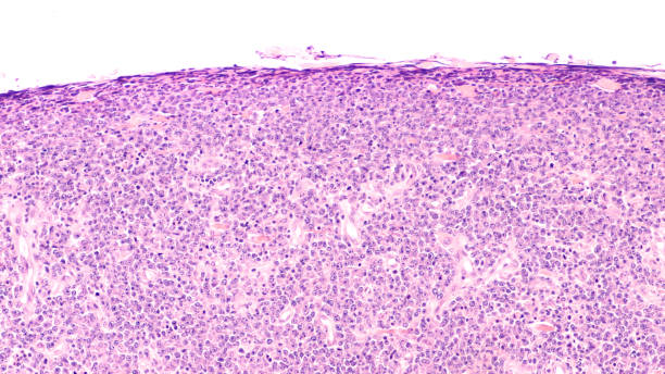 Lymphoma Lymphoma awareness: photomicrograph of a diffuse large B-cell lymphoma (DLBCL) a type of non-Hodgkin lymphoma.  This case is from the testis of an elderly man and shows prominent nucleoli. adenocarcinoma photos stock pictures, royalty-free photos & images
