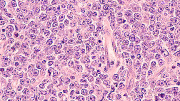Lymphoma Lymphoma awareness: photomicrograph of a diffuse large B-cell lymphoma (DLBCL) a type of non-Hodgkin lymphoma.  This case is from the testis of an elderly man and shows prominent nucleoli. lymphoma photos stock pictures, royalty-free photos & images