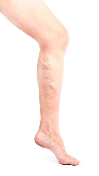 Phlebeurysm disease  on legs on white background. Varicose veins stock photo