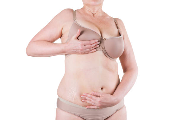 подтяжка живота, дряблая кожа на толстом животе, концепция пластической хирургии - overweight tummy tuck abdomen body стоковые фото и изображения