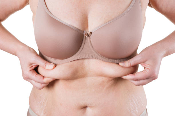 istock Tummy tuck, flabby skin with stretch marks on a fat belly, plastic surgery concept 1176336237