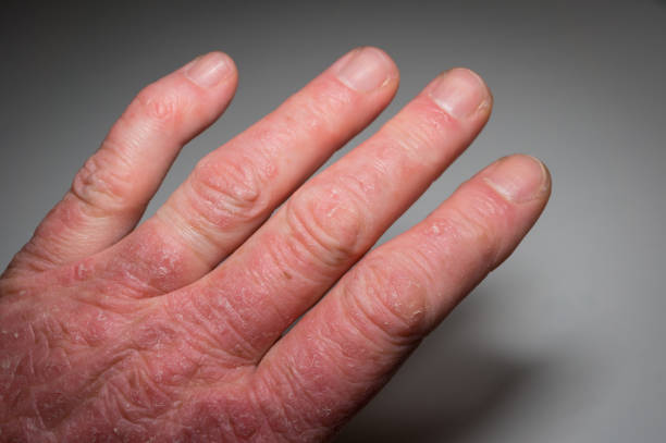 Hand of a psoriasis patient close-up. Psoriatic arthritis. Joint deformation and inflammation on the skin. Photo with dark vignetting. Soft focus. Hand of a psoriasis patient close-up. Psoriatic arthritis. Joint deformation and inflammation on the skin. Photo with dark vignetting.Soft focus. arthritis stock pictures, royalty-free photos & images