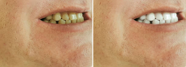 istock male teeth before and after bleaching, treatment 1176490817
