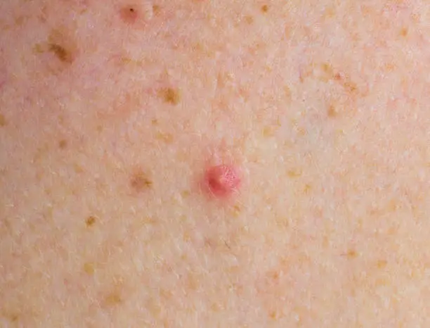 Red pimple on face macro, abscess and acne, whelk