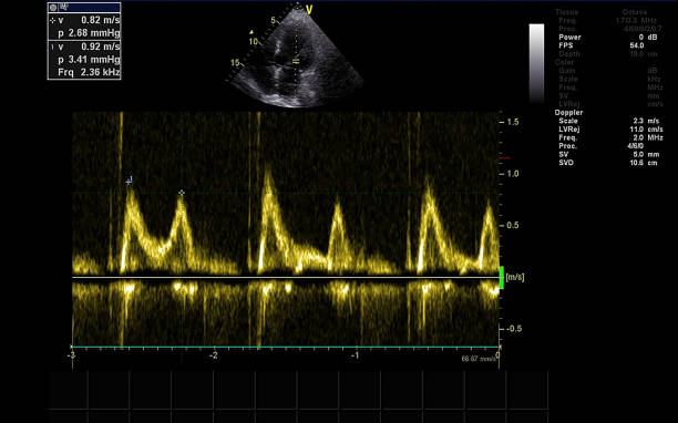 istock Screen of echocardiography (ultrasound) machine. 1176576878