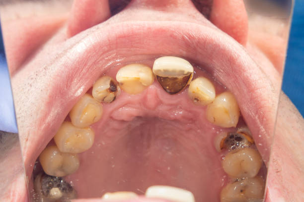 istock human tooth decay close-up at the dentist's appointment. Poor oral hygiene, prevention 1176647601