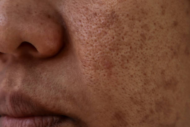 Problema de pele, close-up da pele do rosto de mulheres asiáticas com melasma.