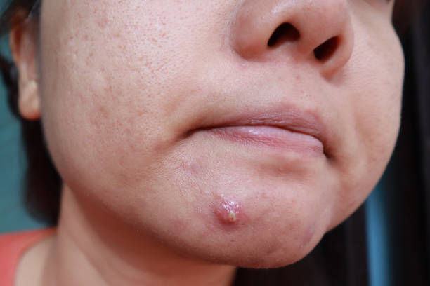 istock Woman squeezing pimple with dirty bare hands, Removing pustules whitehead acne from face, Problems with acne and scar on the female skin. 1176722176