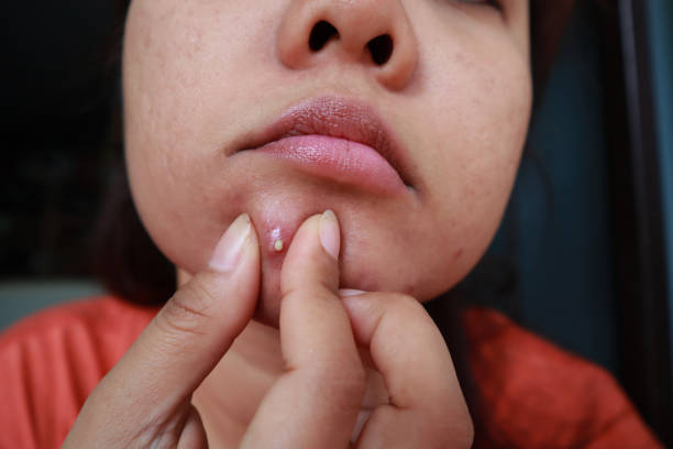istock Woman squeezing pimple with dirty bare hands, Removing pustules whitehead acne from face, Problems with acne and scar on the female skin. 1176722177