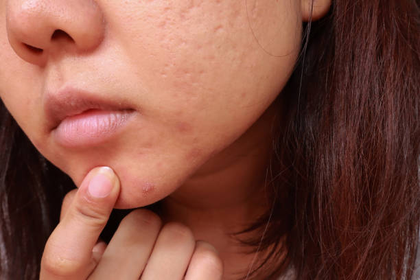 istock Pustules whitehead acne from face, Problems with acne and scar on the female skin, Skin problem 1176722619