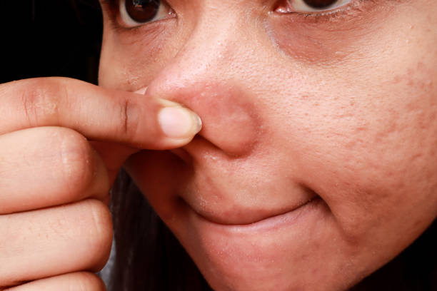 istock Woman pointing finger at blackhead acne from face, Problems with acne hormonal pimples and scar on the female skin, Skin problem 1176722748