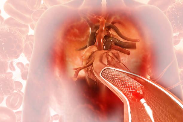 istock Stent angioplasty on scientific background 1176736089