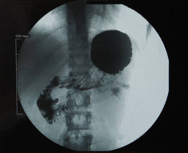 istock X-ray stomach, gastrointestinal tract. Diverticulum. 1176774516