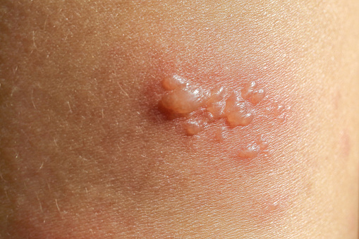 skin rash as allergic symptoms due to arm fiberglass castShingles, Zoster or Herpes Zoster symptoms on arm