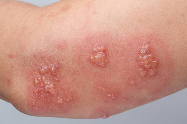 istock Shingles, Zoster or Herpes Zoster symptoms on arm 1176815624