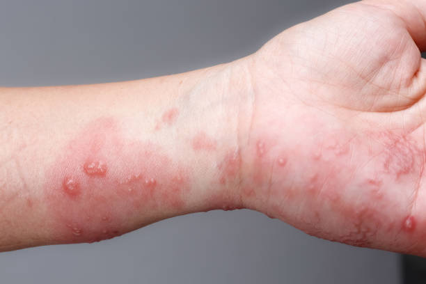 istock Shingles, Zoster or Herpes Zoster symptoms on arm 1176815720