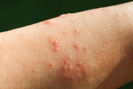 Síntomas de culebrilla, Zoster o Herpes Zoster en el brazo photo