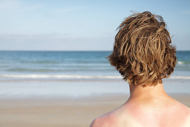 Poparzony słońcem Surferka – zdjęcie