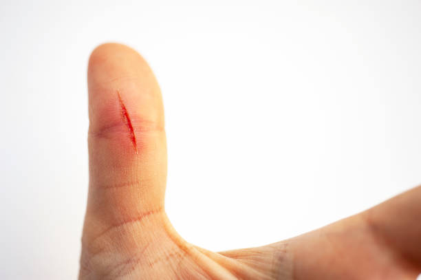 Wound on Human Finger stock photo