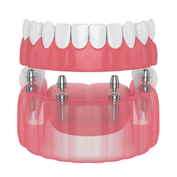 3d renderizado de prótesis parcial del implante - premolar fotografías e imágenes de stock