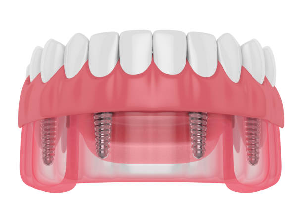 3d render of implant partial denture