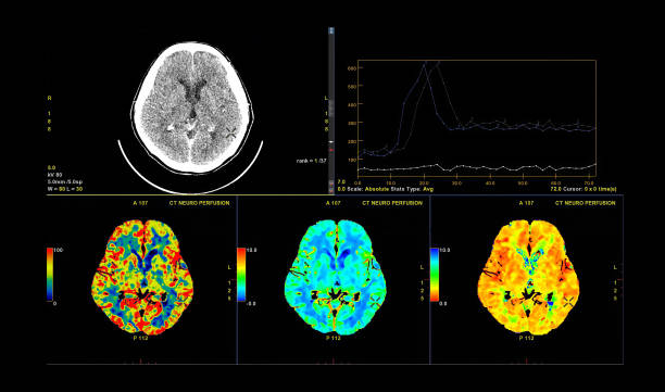 tomografía computarizada de la perfusión cerebral o imagen de tomografía computarizada del cerebro 3d renderizando imagen analizando el flujo sanguíneo cerebral en el monitor. - computed fotografías e imágenes de stock