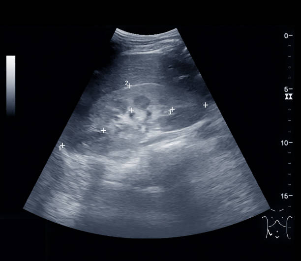 ultrasound upper abdomen showing size of kidney. - human upper body xray imagens e fotografias de stock
