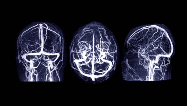 mrv mózg lub venografia rezonansu magnetycznego mózgu na nieprawidłowości w drenażu żylnym mózgu - brain physical injury x ray image x ray zdjęcia i obrazy z banku zdjęć