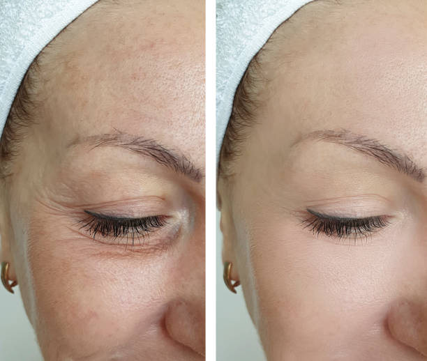 woman eyes wrinkles before and after treatment woman eyes wrinkles before and after treatment botox before and after stock pictures, royalty-free photos & images