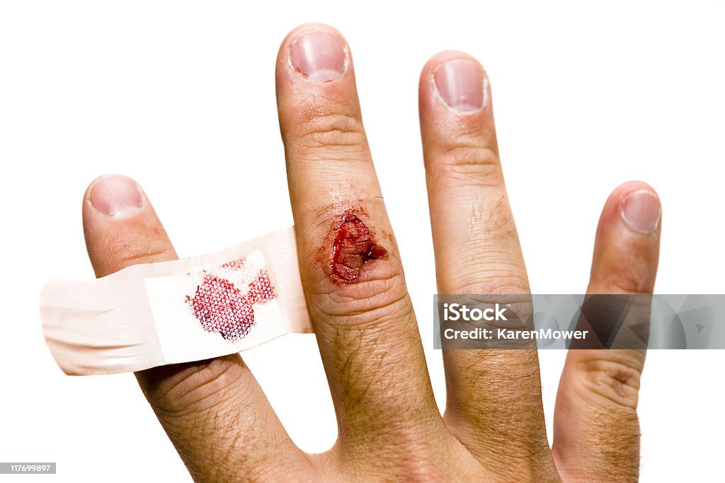 Mão de lesões - Foto de stock de Machucado royalty-free