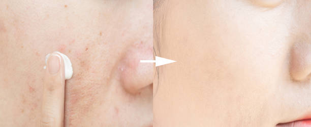 istock Acne scars and pores. Black spots, wrinkles and skin problems 1177149809