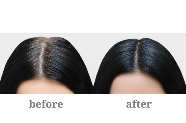 Head Of A Girl With Black Gray Hair Hair Coloring Before And After Stock  Photo - Download Image Now - iStock
