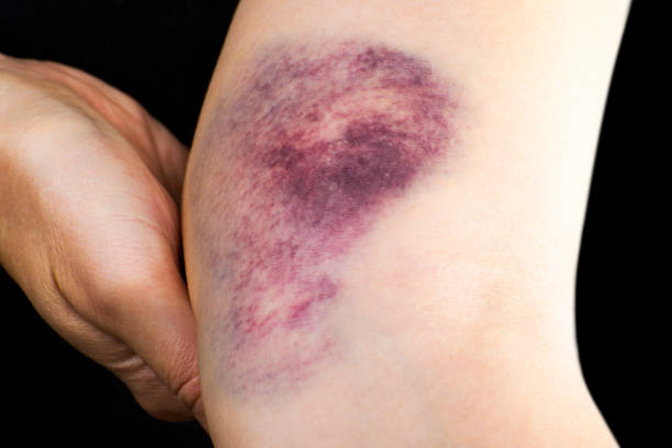 Hematoma on Woman Arm Close up of a hematoma on woman arm near elbow. hematoma images stock pictures, royalty-free photos & images
