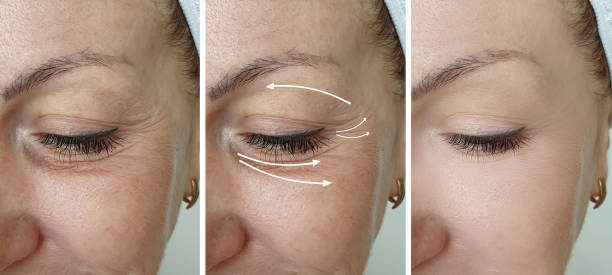 woman face wrinkles before and after treatment woman face wrinkles before and after treatment botox before and after stock pictures, royalty-free photos & images