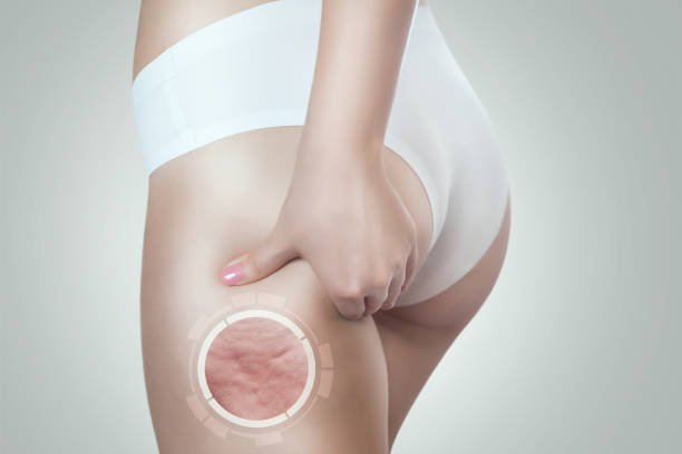 la mujer muestra celulitis en el muslo. tratamiento de la obesidad. - celulitis tipos de piel fotografías e imágenes de stock