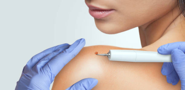 istock A beautician removes a large ugly mole from a woman