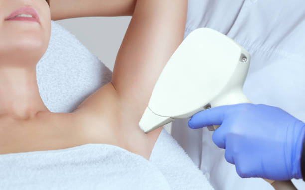 the cosmetologist does the laser hair removal procedure in the armpit zone, to a young woman in a beauty salon. - waxing armpit women beauty treatment imagens e fotografias de stock