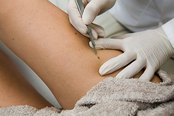 Dermatologist removing moles with tools A stock photo of a doctor removing moles on a patients leg with a scalpel. melanin photos stock pictures, royalty-free photos & images