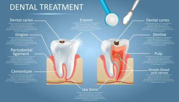 Vector illustration of Dental treatment vector diagram education medical anatomy poster infographics