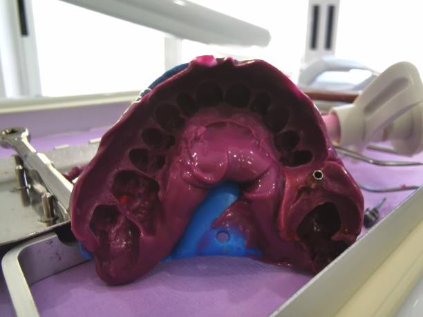 istock imprint of a bite for implant 1177437816