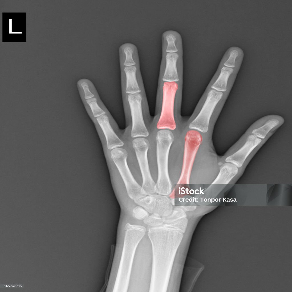 Abnormal Hand Rx Film Xray Both Hand Ap Show Abnormal Joint Humans Hands On Black ...