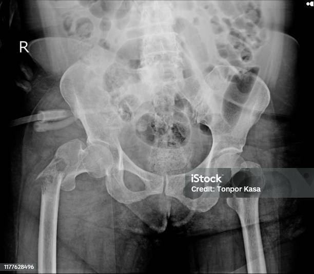 Xray Both Hip Finding Fracture Rigth Femur Stock Photo - Download Image Now - Anatomy, Biology, Doctor