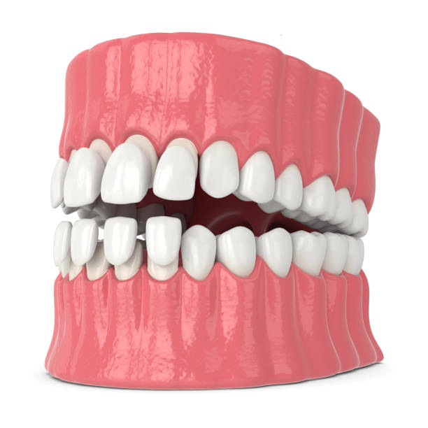istock 3d render of jaw with upper and lower veneers 1177646920