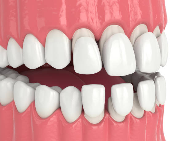 istock 3d render of jaw with upper and lower veneers 1177647439