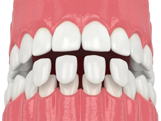 3d render of jaw with lower veneers 3d render of jaw with lower veneers over white teeth bonding stock pictures, royalty-free photos & images